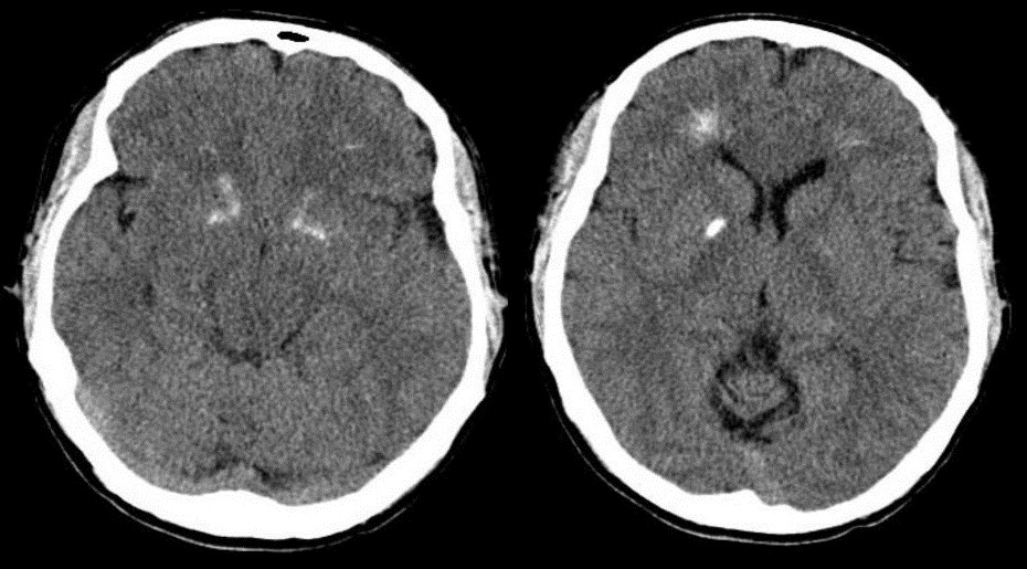 DiGeorge syndrome