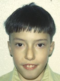 DiGeorge syndrome